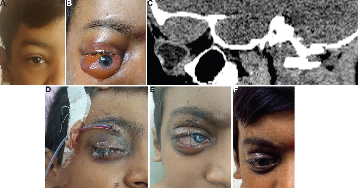 (A) The patient on presentation after trivial trauma to the forehead, with swelling seen on the right eye. (B) Increased intraorbital swelling causing severe proptosis with exposure keratopathy causing decrease in vision. (C) Computed tomography orbit showing hyperdense biconvex lesion in the superior orbit, suggestive of subperiosteal haematoma with the orbital roof intact. (D) After wide-bore needle aspiration, drain was put as there was continuous bleed. (E) Postoperative one-week proptosis completely reduced with resolving corneal infiltrates. (F) At one-month follow up, the patient had an inferior corneal opacity with vision of 6/12.
